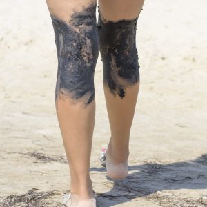 Treatment of mud joints of feet on the seashore